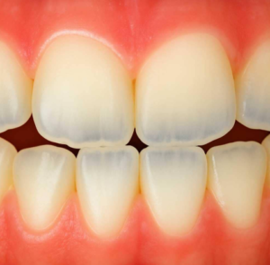 5 Factors That Determine Whether Enamel Changes Need Treatment